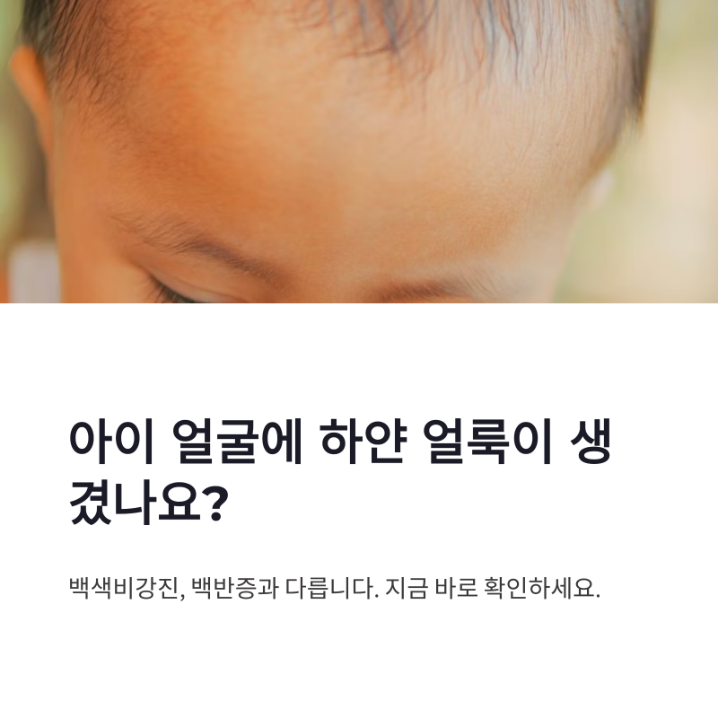 백색비강진 증상 백반증과 차이점부터 관리법까지 정리