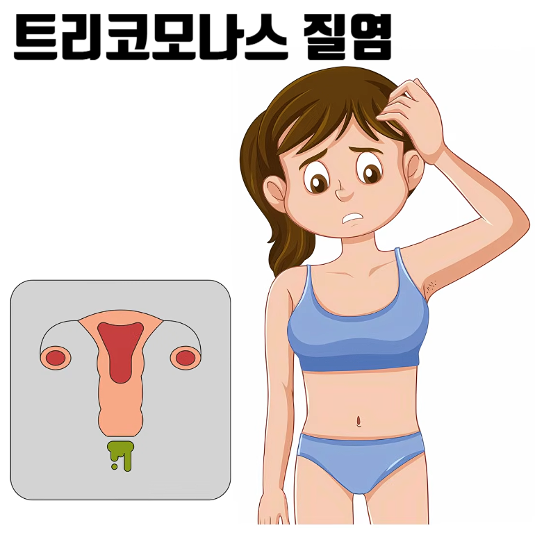 트리코모나스 질염 증상 원인, 칸디다 세균성 차이, 핑퐁감염 동반치료