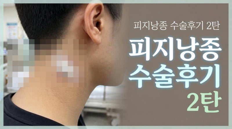 지방종인줄 알았던 목뒤 혹 피지낭종 제거 수술 후기, 2탄