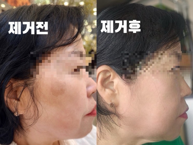  신논현피부과 흑자레이저 후기 2탄｜엄마 친구들도 병원 알려달라고 한 이유