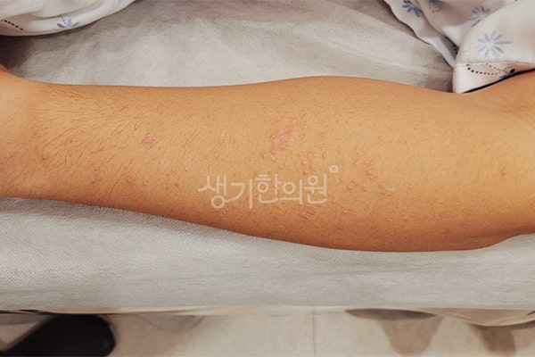 설문동피부과증상, 손등에 좁쌀 같은 게 갑자기 번진다면, 편평사마귀일 수 있습니다