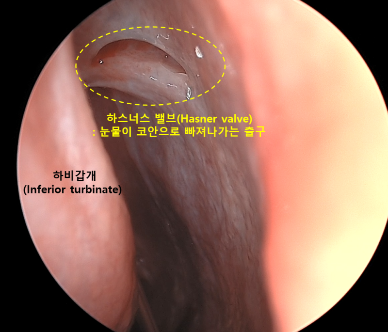 눈물이 자꾸 흐른다면? 코내시경을 이용한 실리콘관 삽입술(Silicone Tube Intubation, STI) [눈물길....