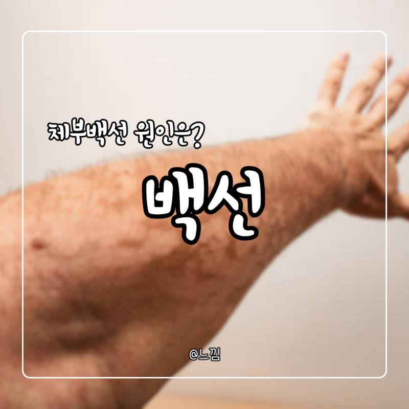 백선 증상 체부백선 원인 전염 치료