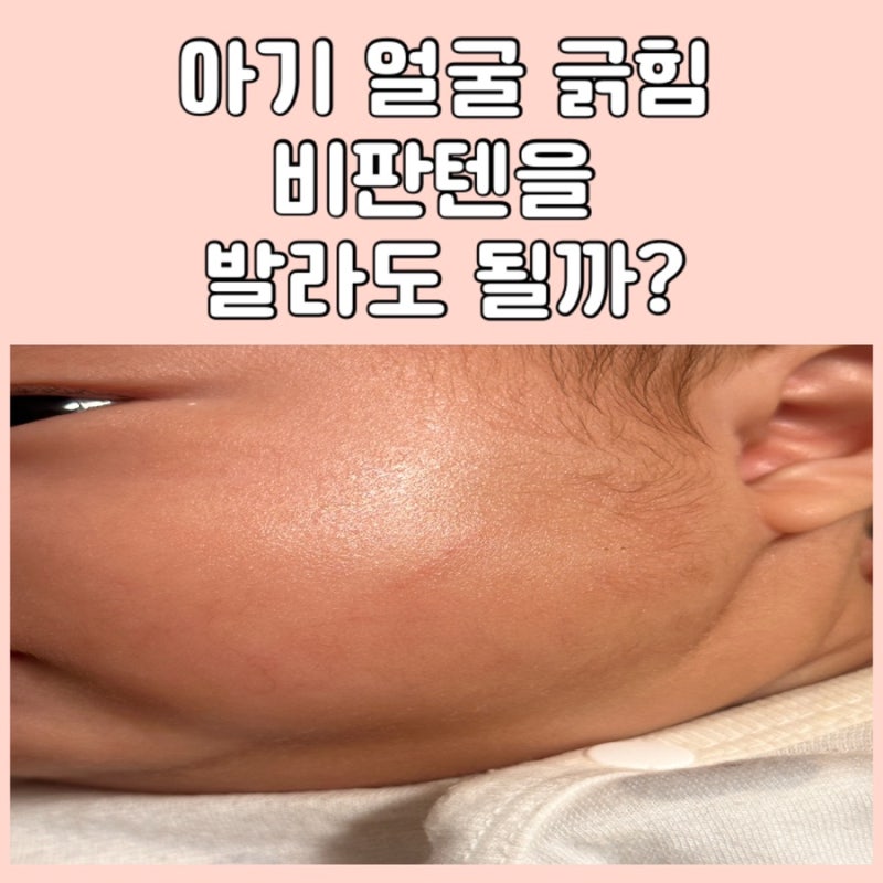 아기얼굴 긁힘 상처 비판텐 사용법 주의사항 연고로 관리해본 후기