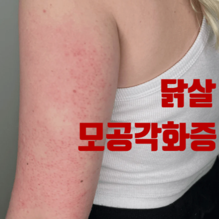 모공각화증 원인 유전 개선방법, 오돌토돌 닭살 뱀살 몸드름 연고 크림 추천