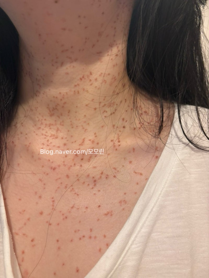 분당 편평사마귀 성지 무제한 전신 제거 후기