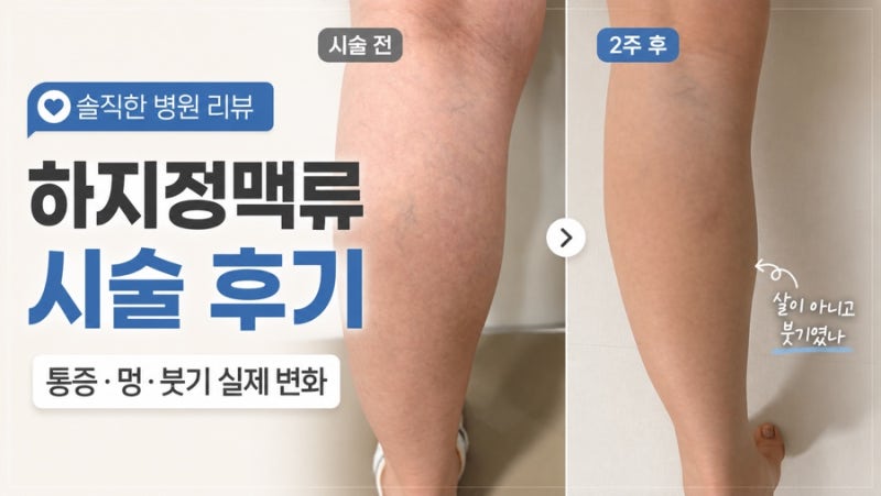 하지정맥류 경화술 후 등산까지｜통증·멍·붓기 4주 솔직후기 (1탄!)