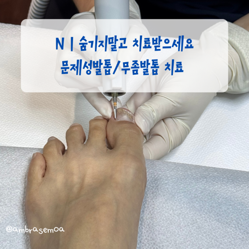 인천발톱무좀병원 | 변색되고 깨진 문제성발톱 치료기
