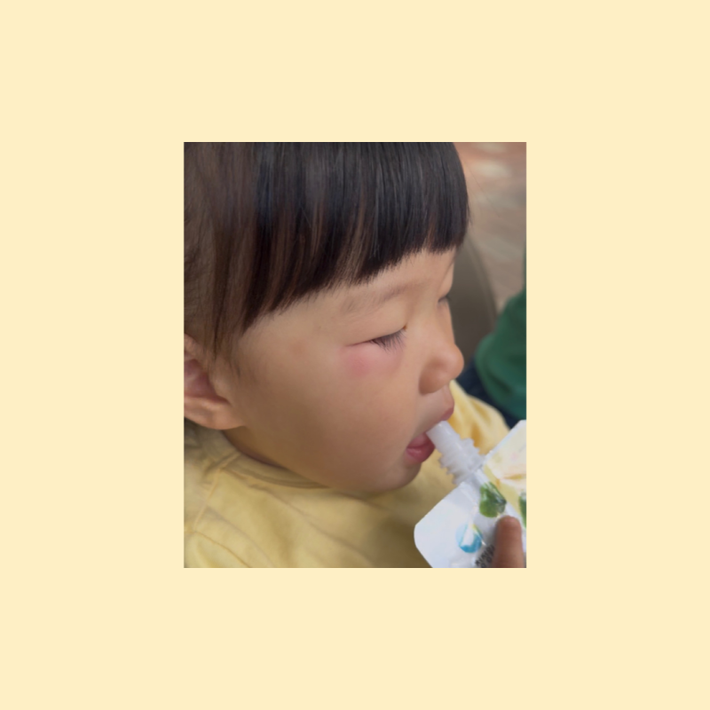 아기 모기 물렸을 때 눈 밑이 퉁퉁, 소아과 가야 할까?