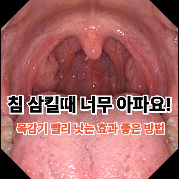 침 삼킬때 너무 아파요! 목감기 빨리 낫는 효과 좋은 방법