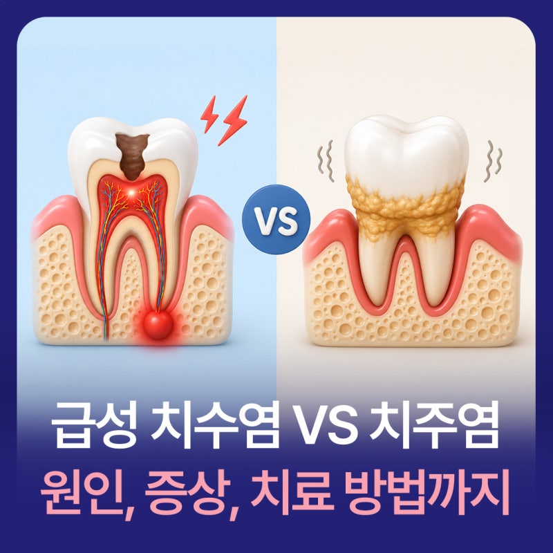 급성 치수염 VS 치주염 원인, 증상, 치료 방법까지