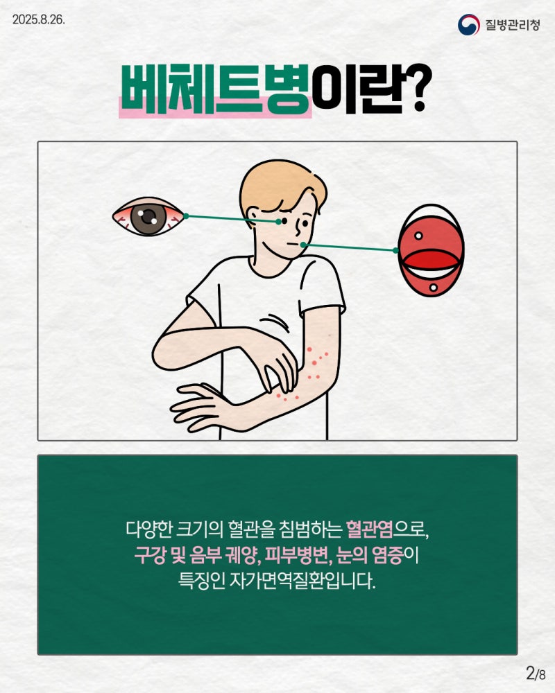 베체트병이란? 구강궤양·외음부궤양 반복된다면 의심해야 할 증상 총정리
