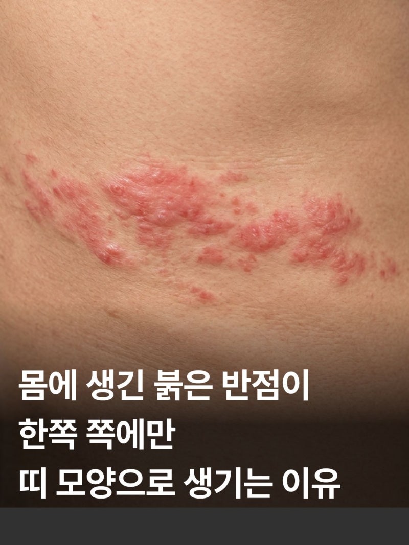 대상포진 초기 모양 가려움 수포 전염성 및 치료 방법 (+병원 치료 후기)
