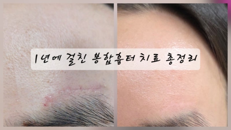 실밥 제거 후 흉터 치료 루틴 11 : 강남수병원 이마 봉합 수술, 내가 직접 실천한 리얼 후기 (....