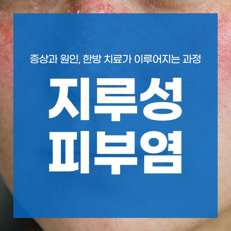 안면 지루성 피부염 증상과 원인, 한방 치료가 이루어지는 과정