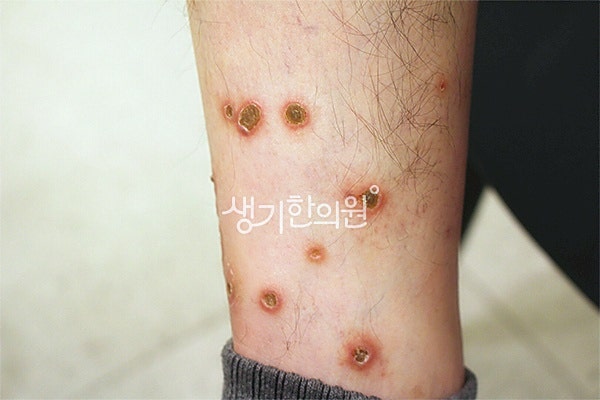 광주남구피부과질환 결절성양진, 긁을수록 심해지는 악순환을 끊어야 합니다