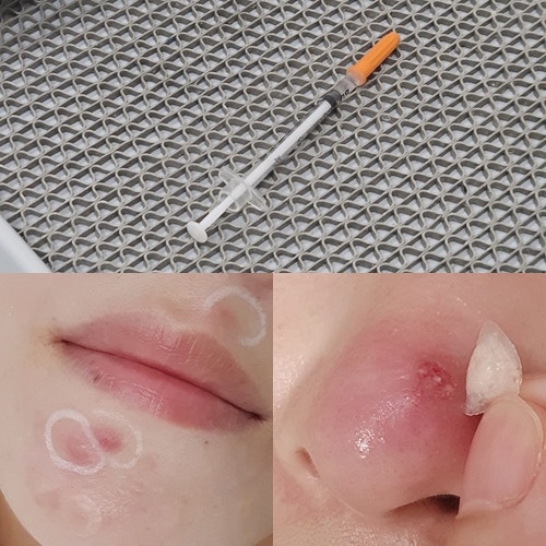 속 여드름 염증주사 고인물의 가격, 패임, 효과, 주기, 후기 총정리