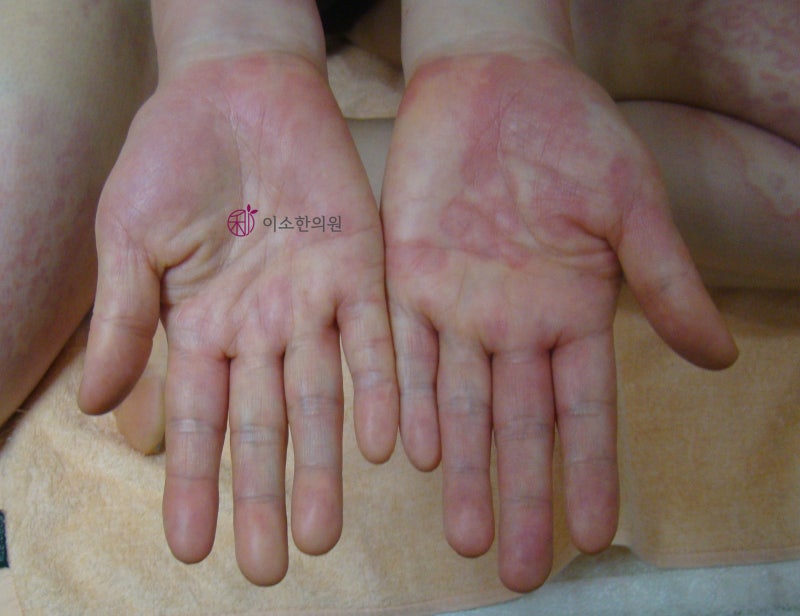 결절홍반,원심고리홍반, 다형홍반 차이점, 주의사항 - 피부붉어짐