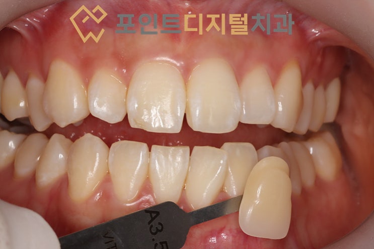 [아산 치아미백] 누런 이 고민 끝! 20대 환자분의 '미백폭발코스'로 완성한 하얀 미소 (A3.5에서 BL4까지!)