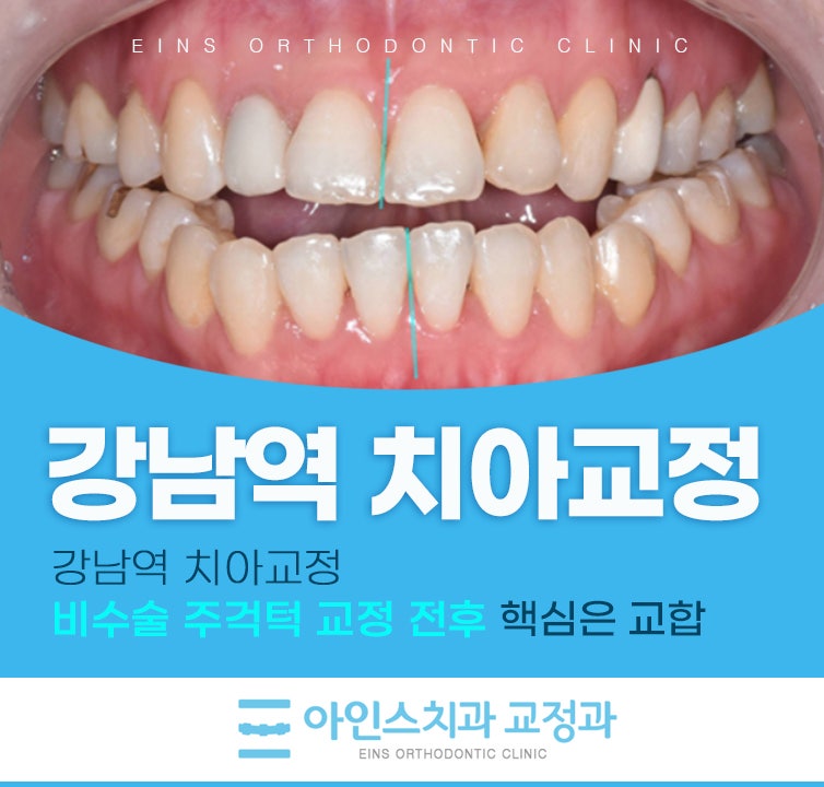 강남역 치아교정 비수술 주걱턱 교정 전후 핵심은 교합