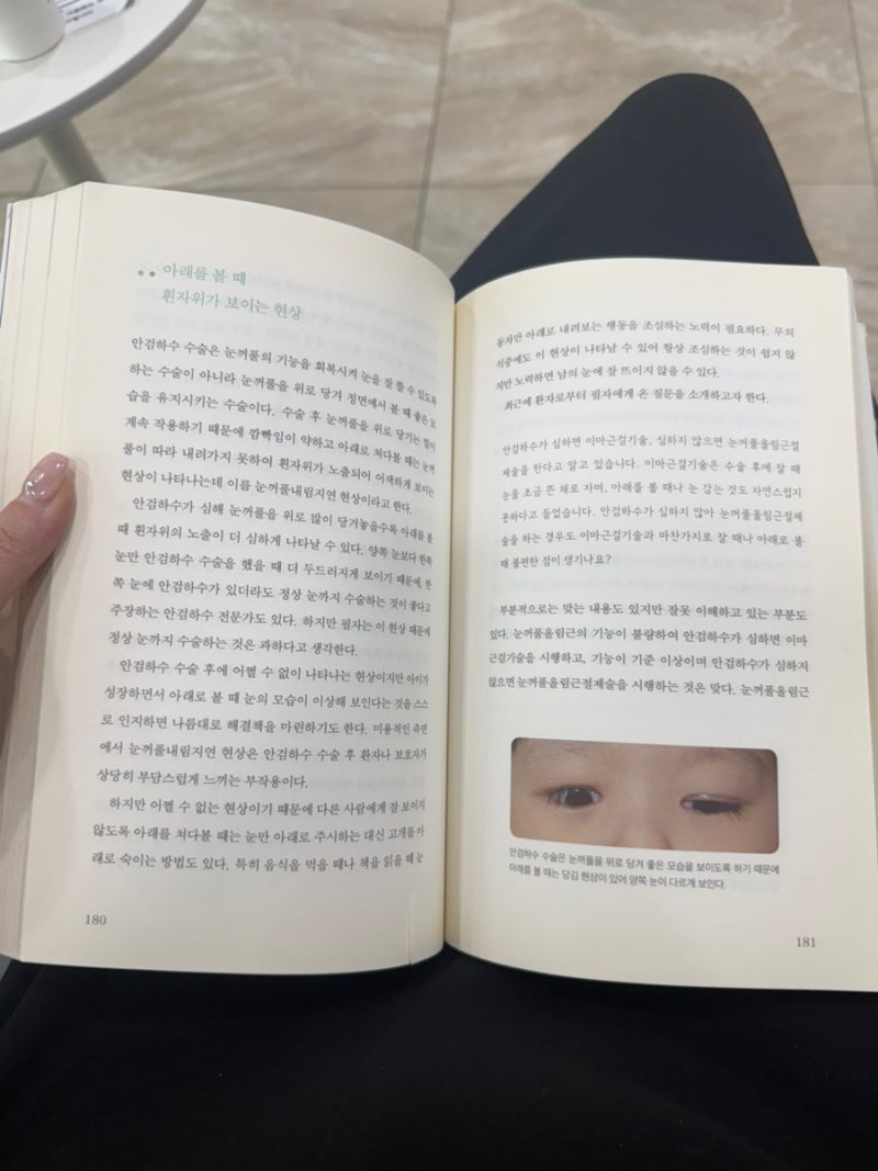 선천성 안검하수 안검내반 명의 이상열 교수님 용산 우리연세안과 이마근걸기술 후기
