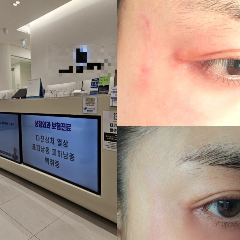 켈로이드 흉터 레이저 5차 후기 6개월 동안 달라진 변화와 솔직한 만족도