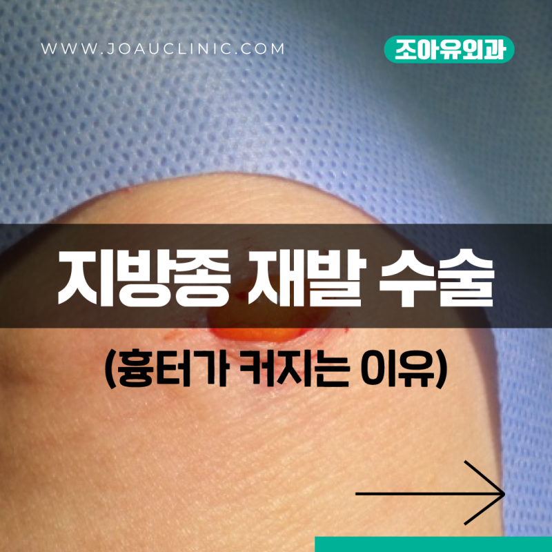 팔 지방종 제거 수술 재발 시 흉터가 커질 수밖에 없는 이유