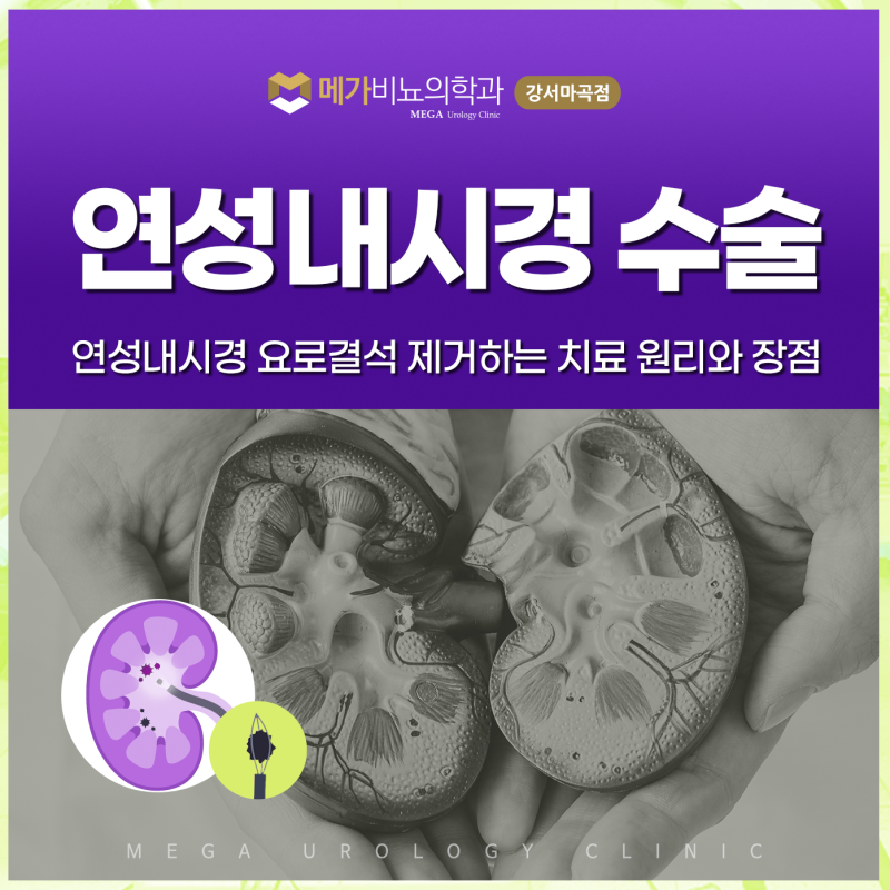연성내시경 수술, 요로결석 제거하는 치료 원리와 장점