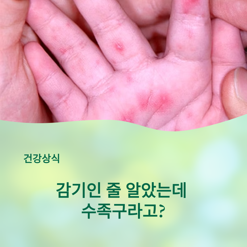 "감기인 줄 알았는데 수족구라고?"… 명이도 강조하는 초기증상 구별법과 반전 식단