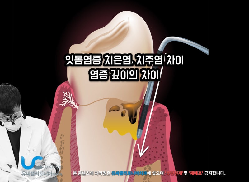 잇몸염증 치은염 치주염증상 차이 간단합니다