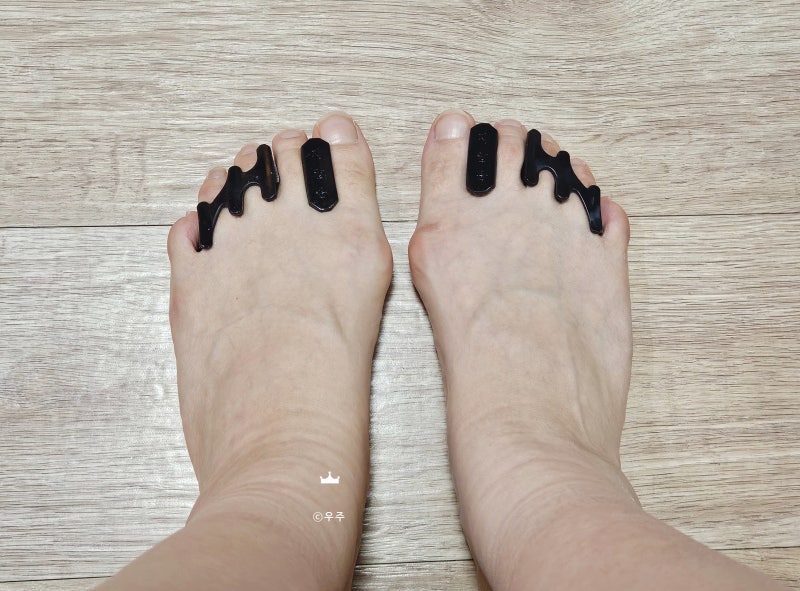 무지외반증 통증으로 고민하다가 발가락 교정기 착용후기