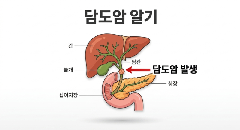 "눈이 노래지고 몸이 가렵다면? '담도암'은 왜 발견이 늦을까?" '담도암'의 증상, 원인, 치료 ....