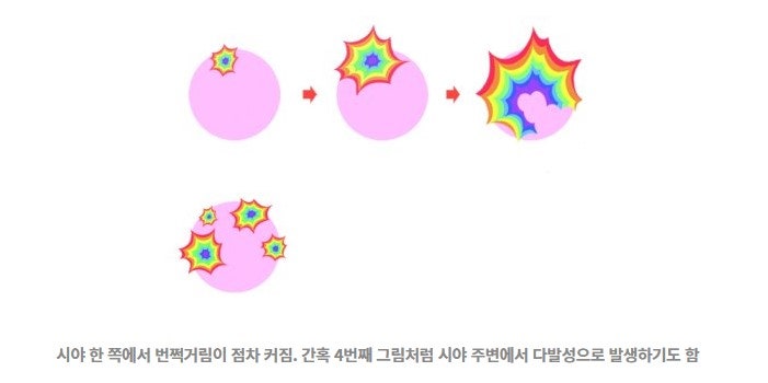시각성 편두통