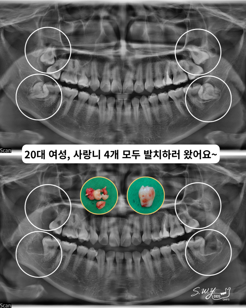 사랑니 발치비용 얼마나 들까요? 수면사랑니/ 인천 부평 매복사랑니 발치 사례