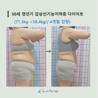 갱년기 붓기, 아침 얼굴과 저녁 다리가 달라집니다