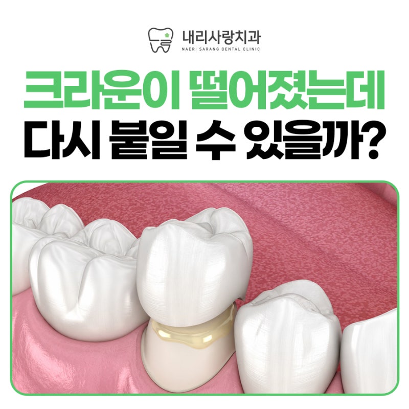 봉담읍치과 크라운 재부착 가능할까?