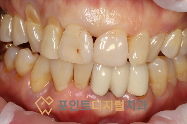 천안 앞니 레진 재치료, 환자분의 의견을 최우선으로 생각하는 포인트디지털치과 (feat. 바이오클리어)