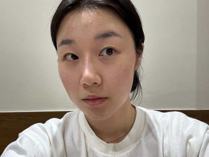웨딩관리 강남턱보톡스맛집 내돈내산 후기 :: 볼패임 없음