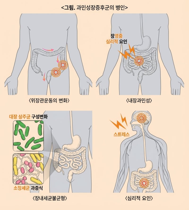 과민성 대장증후군 증상, 대장암과 다를까?