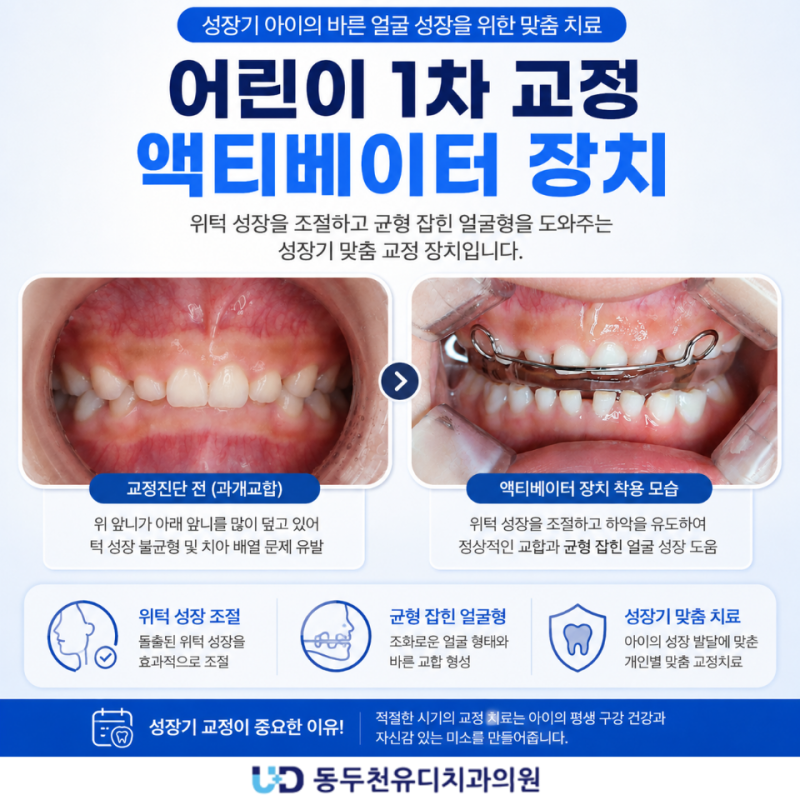 동두천유디치과 | 아이의 무턱이 걱정된다면? 액티베이터(activator) 교정치료