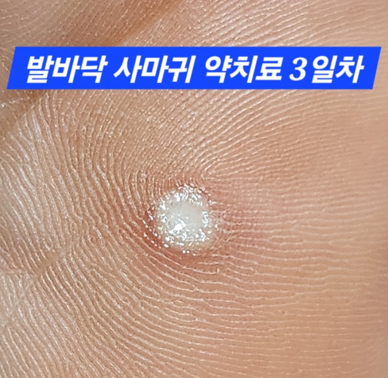 3일차] 발바닥 사마귀 약치료