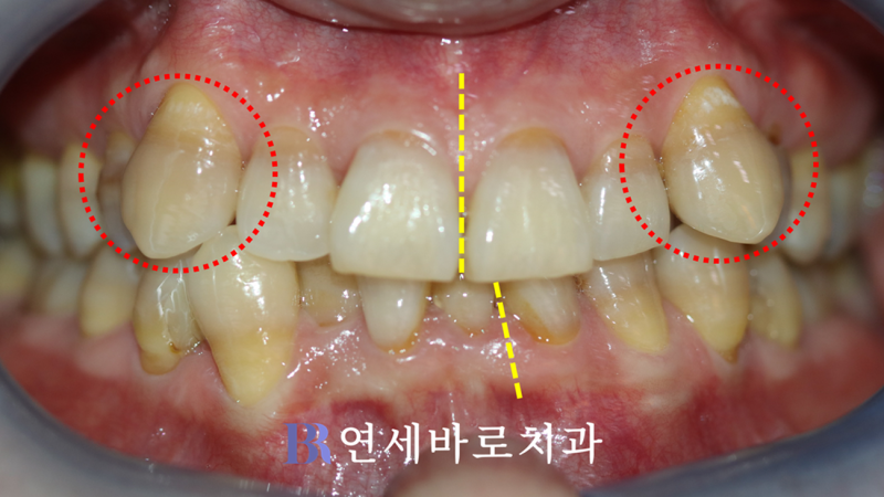 대전 둔산동치과 발치교정으로 합죽이가 된다고요?