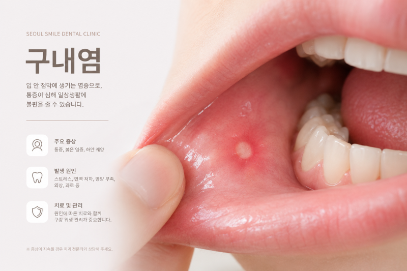 혓바늘 빨리 낫는 법! 입안에 자꾸 생기는 구내염 원인 총정리
