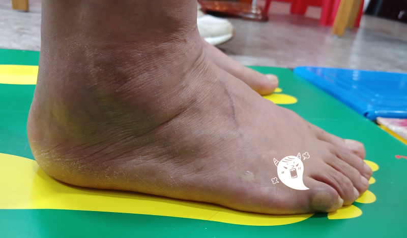 티눈(여)발가락 복숭아뼈 굳은살