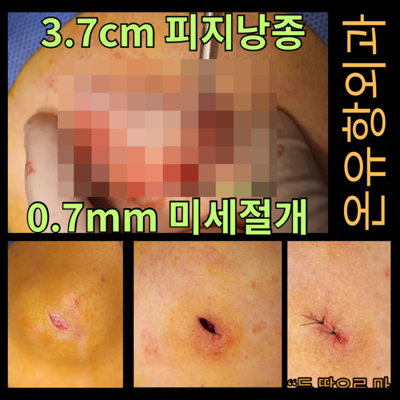 평택 오산 피지낭종 수술 후 왜 어떤 사람은 2주 만에 티가 안 날까?