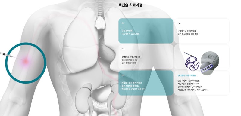 정계정맥류 증상 원인과 치료, 정계정맥류 색전술 Q&A