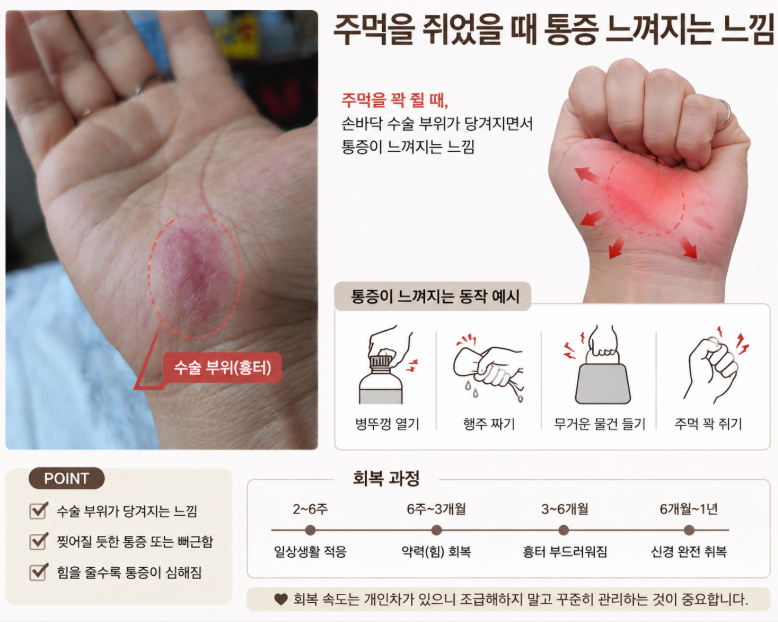 손목터널증후군 수술 후 주먹이 안 쥐어진다면? 실제 수술 후기와 회복 과정