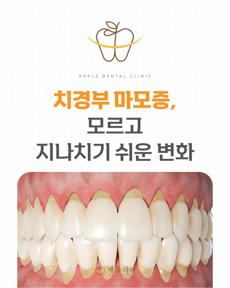 치경부 마모증, 충치와 헷갈리기 쉬운 이유