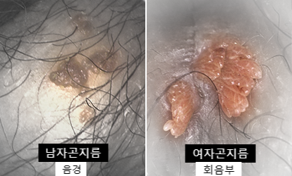 곤지름 부위별 완치 기간, 민망해서 치료를 미뤘더니