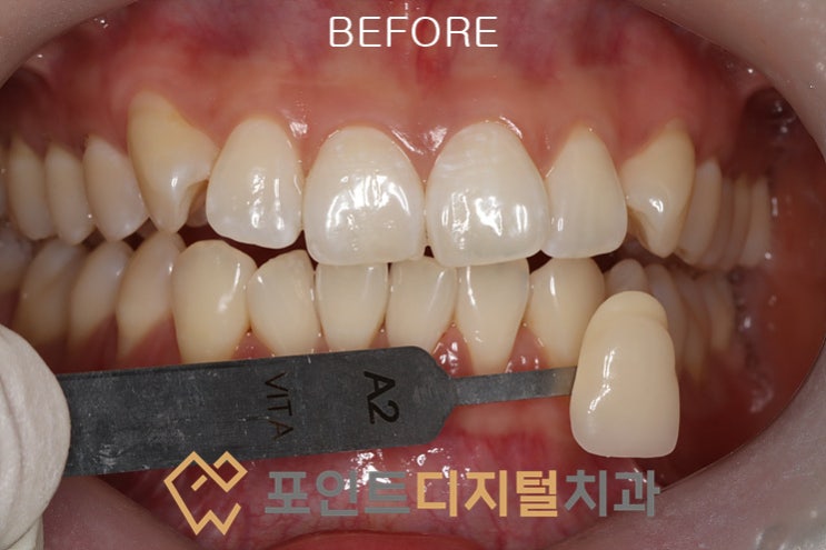 [불당 치아미백] 3일 뒤 중요한 행사? 30대 여성 환자분의 하루 만에 끝내는 원데이 치아미백 후기 (A2 → BL3)